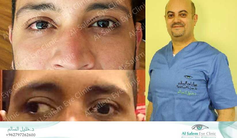 ، إحتمالية عودة الحول بعد العملية، هل يعود الحول بعد العملية؟ ، نتائج عملية الحول ،ازدواج الرؤية بعد عملية الحول، شكل العين بعد عملية الحول