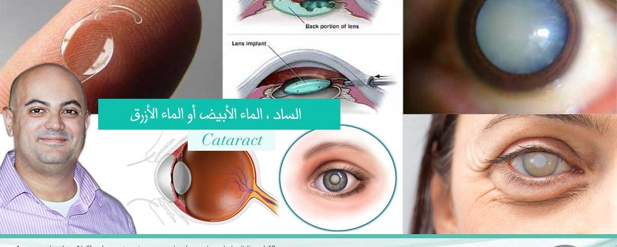 الماء الأبيض او الماء الأزرق هو إعتام عدسة العين ساد العين و خطوات عملية الفاكو النصائح بعد عملية الساد