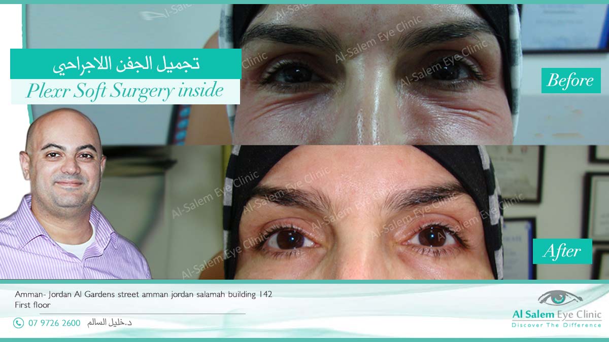 تجميل الجفن اللاجراحي ( بلكسر ) : التقنية الاحدث و الأسرع في شد الجلد المترهل حول العين