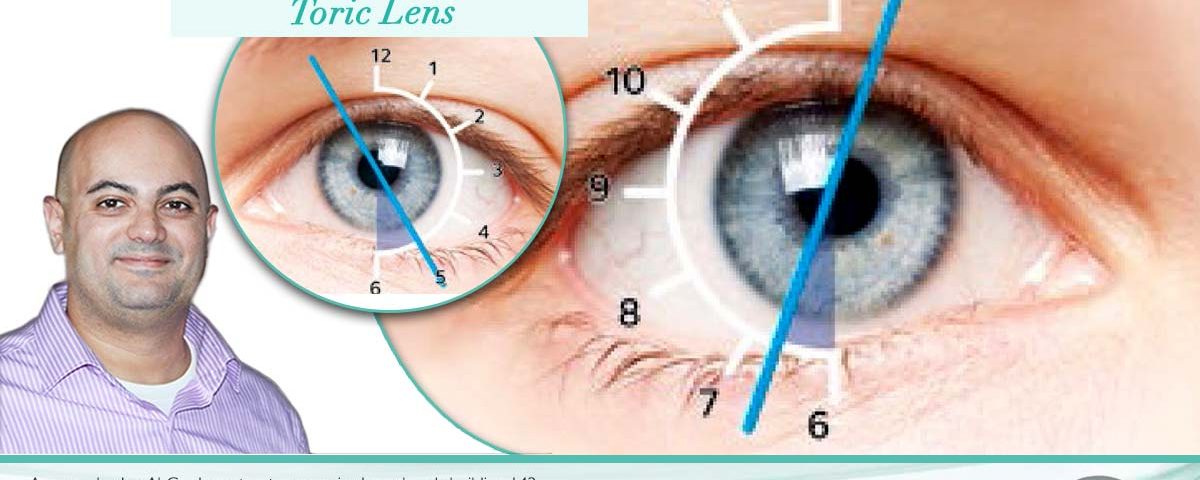 سعر زراعة عدسات ICL عيوب زراعة العدسات ، عيوب زراعة العدسات ICL ، أسعار عدسات أكريسوف ، منتديات زراعة عدسات ، متى تتحسن الرؤية بعد عملية زرع العدسة ، من جرب زراعة العدسات ، نصائح بعد عملية زراعة العدسات