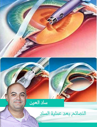 Cataract for medical students