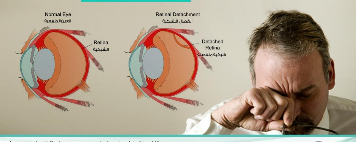 إنفصال الشبكية من الحالات الطارئة انفصال الشبكية الذاتي ، عملية انفصال الشبكية بالسيلكون ، انفصال الشبكية عند الأطفال ، تكلفة عملية انفصال الشبكية في الأردن