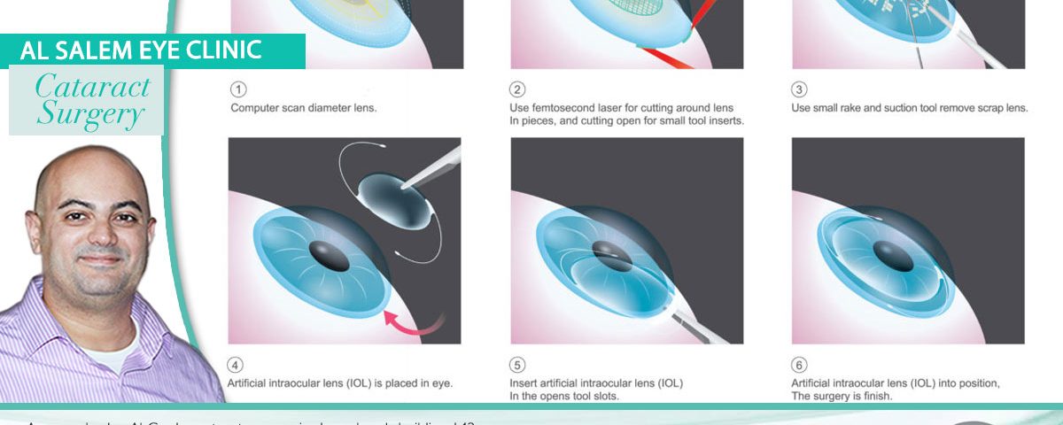 types of lenses implanted for cataract surgery in Jordan