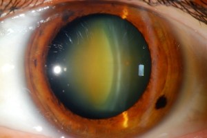 The lecture is for medical students anatomy of the lens, causes of cataract, complications of cataract surgery. Phacoemulsification