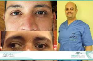 squinting eye, also known as Strabismus, is a medical condition that causes eye deviation . a squint, will lead to Lazy eye in children.
