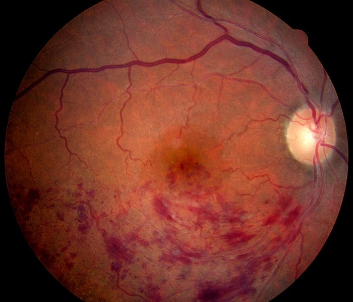 Retinal diseases, detachment Central retinal artery and vein occlusion. diabetic retinopathy and age-related macular degeneration.