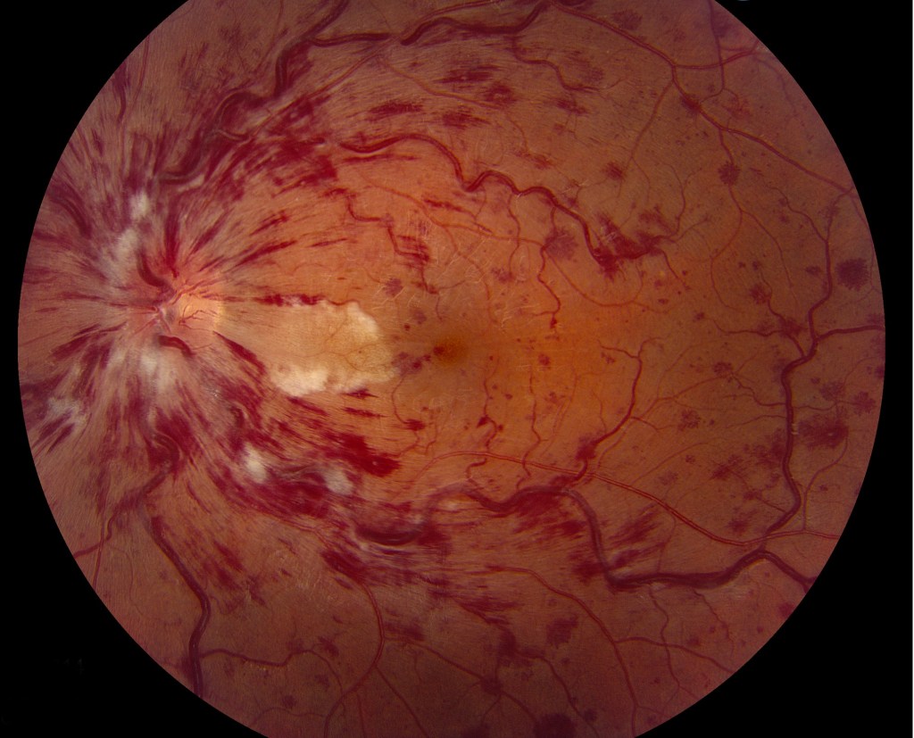 Retinal diseases, detachment Central retinal artery and vein occlusion. diabetic retinopathy and age-related macular degeneration.