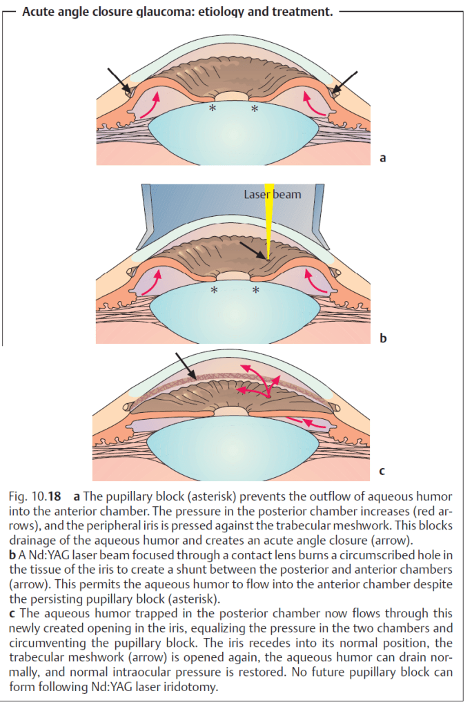 laser Iridotomy for glaucoma