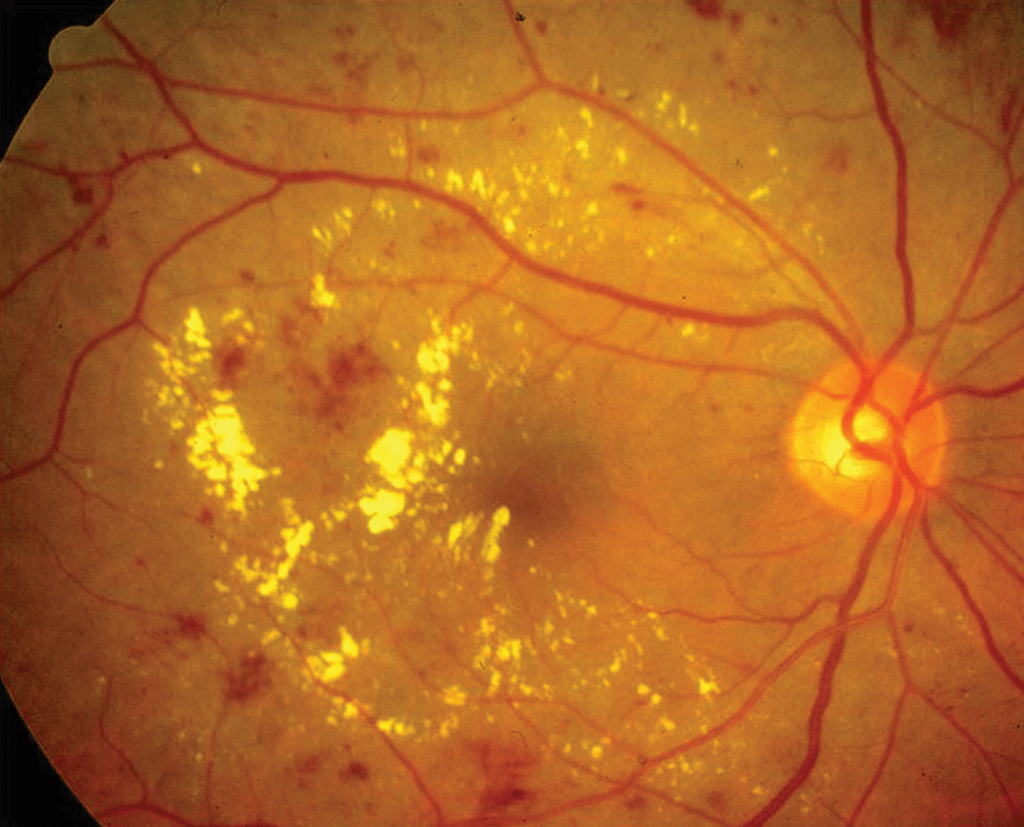diabetic macular Edema