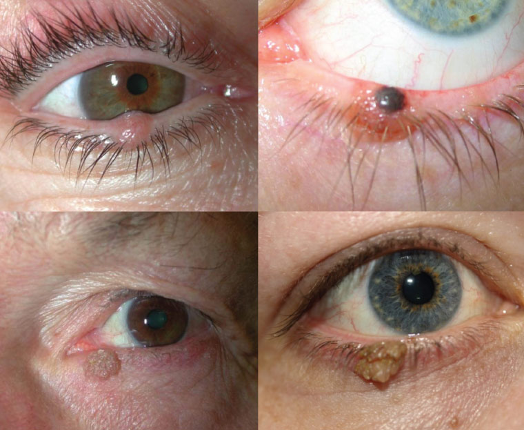Benign eyelid lesions and malignant tumors arising from skin like, basal cell carcinoma, malignant melanoma, squamous cell carcinoma. 