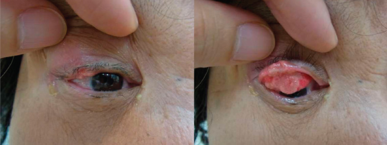 Benign eyelid lesions and malignant tumors arising from skin like, basal cell carcinoma, malignant melanoma, squamous cell carcinoma.