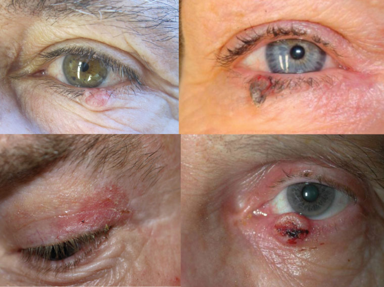 Eyelid Lesions For Medical Students أد خليل السالم