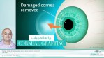 و التي يقوم بها طبيب العيون (أخصائي قرنية) . سنجاوب عن أسئلة تتعلق في زراعه القرنية ، علاج القرنية المخروطية ، إعتام القرنية و نجاح العملية