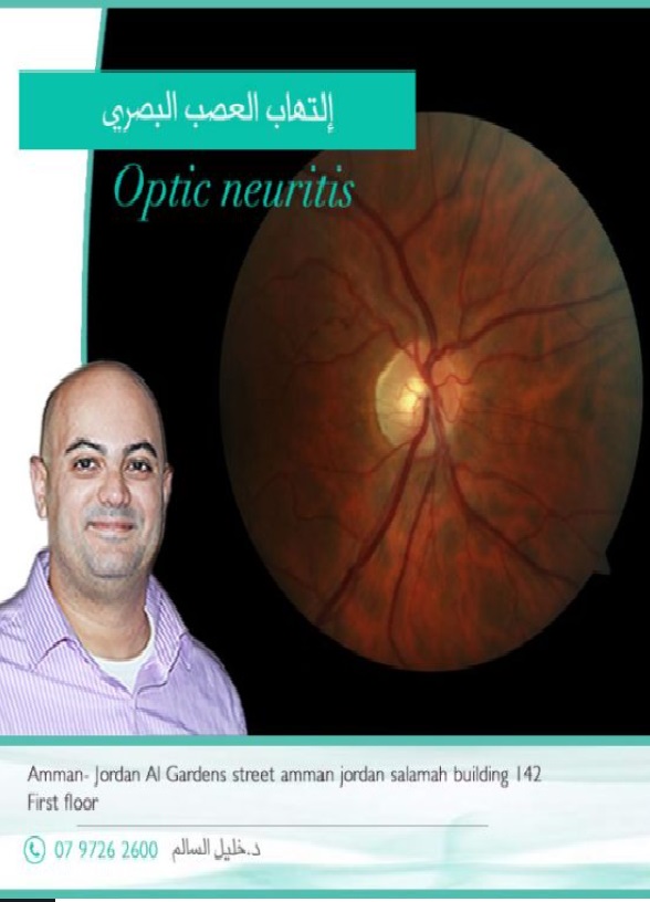التهاب العصب البصري
