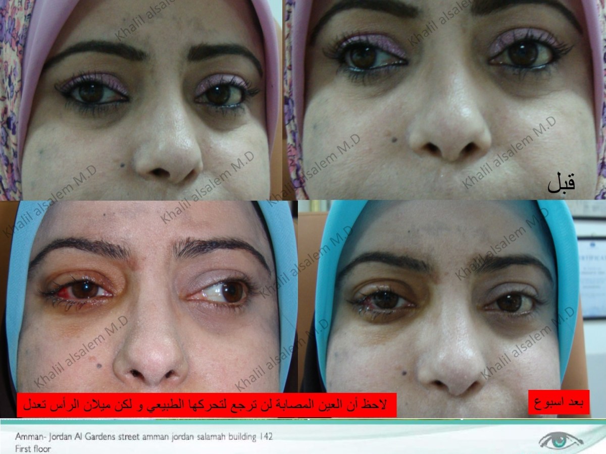 دوين متلازمه ، نصائح من استشاري عيون اطفال، افضل دكتور حول اطفال، تكلفة عملية علاج الحول ، علاج الحول الأنسي ، علاج الحول الوحشي بأرخص و أسرع الحلول