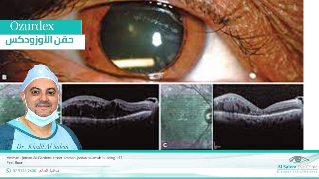 الأوزوردكس، حقنة الكورتيزون في العين ، كيفية إستخدامه ، فوائدة و مضاعفات علاج الأوزوردكس ، نصائح و تعليمات بعد علاج الأزوردكس