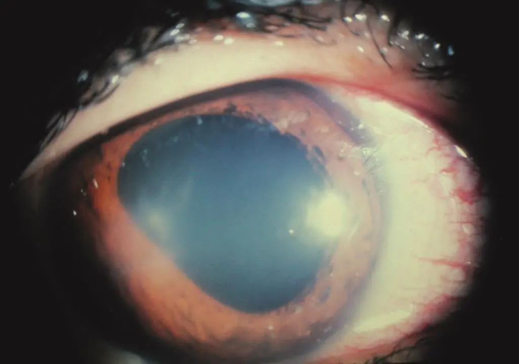 Neuro-ophthalmology II dealt with like Anisocoria, Adie's tonic pupil, Horner's syndrome, transient visual loss and Visual Field Defects