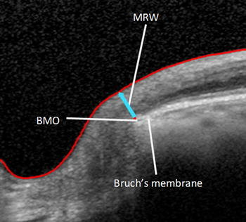 OCT of the optic nerve