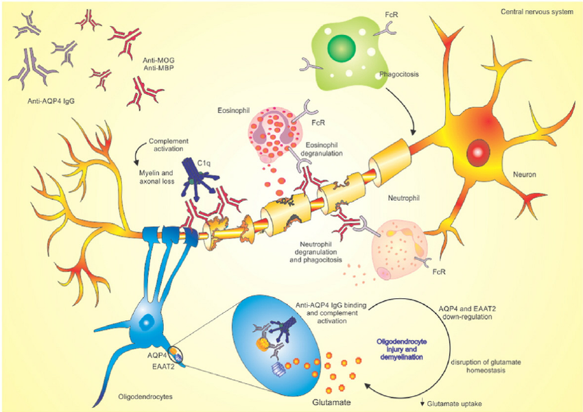 Neuromyelitis Optica Spectrum Disorders (NMOSD) are rare autoimmune diseases affecting the optic nerves and spinal cord. Learn about NMOSD symptoms, antibodies, diagnosis, and modern treatment options.