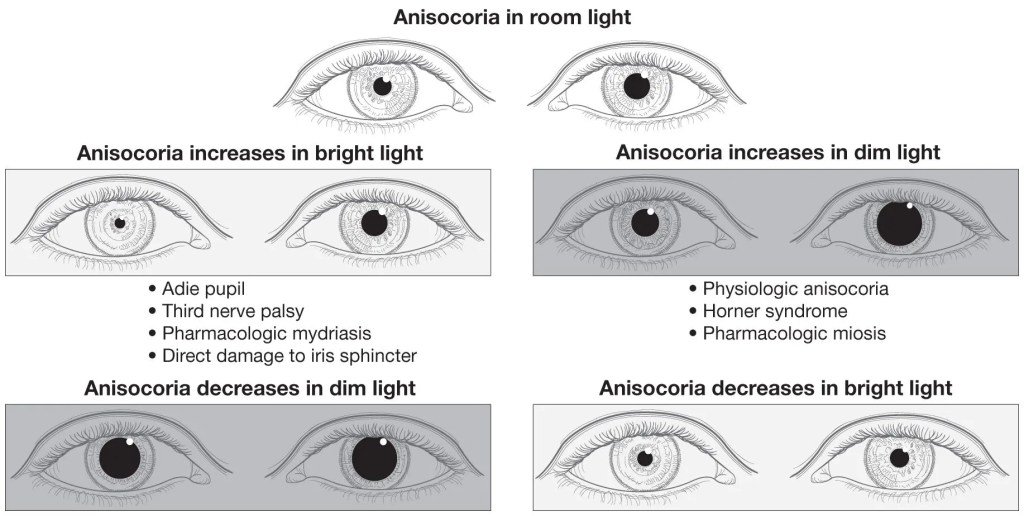 Anisocoria (unequal pupils) explained in a simple clinical approach. Causes Horner syndrome, Adie’s pupil, and medication-induced mydriasis