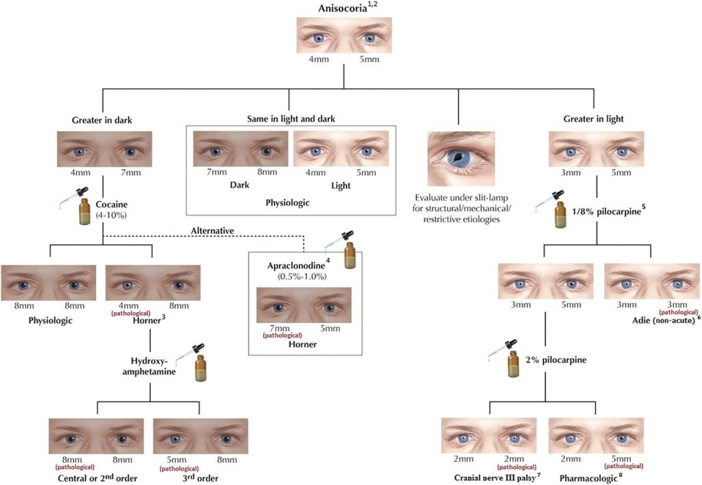 Anisocoria (unequal pupils) explained in a simple clinical approach. Causes Horner syndrome, Adie’s pupil, and medication-induced mydriasis