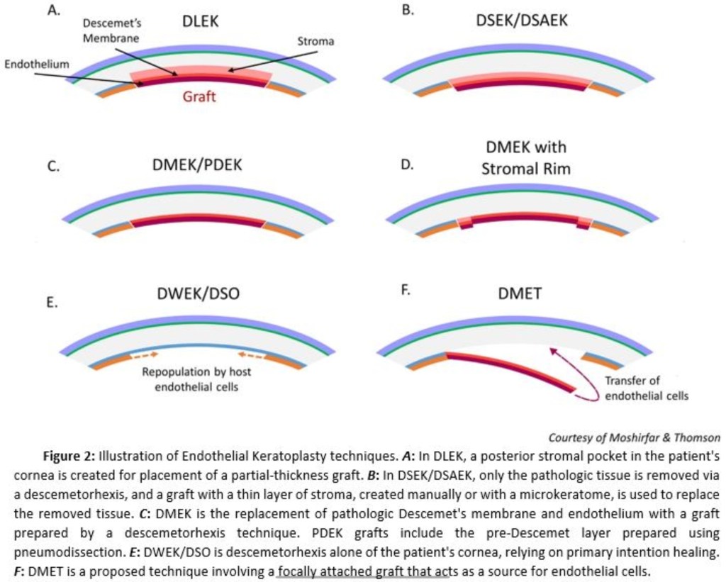 Explore modern corneal transplant surgery techniques including PKP, DALK, DSAEK, and DMEK. indication, complications and complete guide